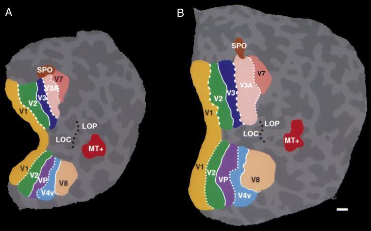 Na figura 35 está representado um cérebro normal, vista anatómica 3D, enquanto que na figura 36 o cérebro é representado a duas dimensões através de uma reconstrução plana.
