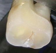 parâmetros de resistência à fratura dos dentes 26.