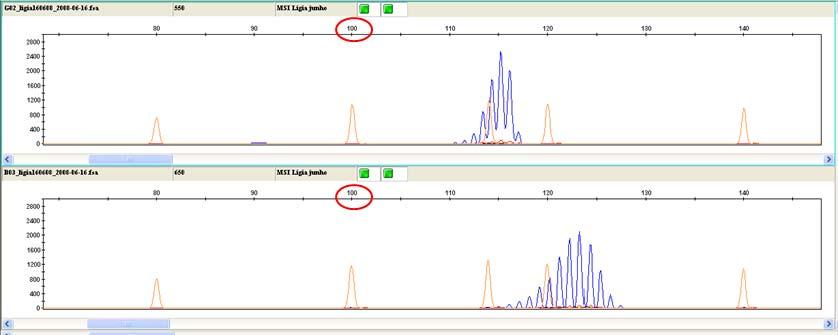 picos da amostra Y amplificada com BAT40 (mucosa normal C02); D: picos da amostra X amplificada com BAT40 (adenocarcinoma F01); E: