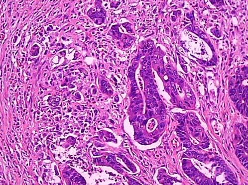 Resultados e Discussão 71 Figura 6 - Fotos de lâminas mostrando casos de adenocarcinomas que apresentam budding. As setas mostram os agrupamentos celulares.