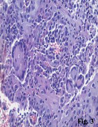 O exame microscópico revelou hiperplasia pseudocarcinomatosa com ulceração da superfície epitelial de recobrimento e inflamação crônica granulomatosa (Fig, 2) e granuloma com células gigantes