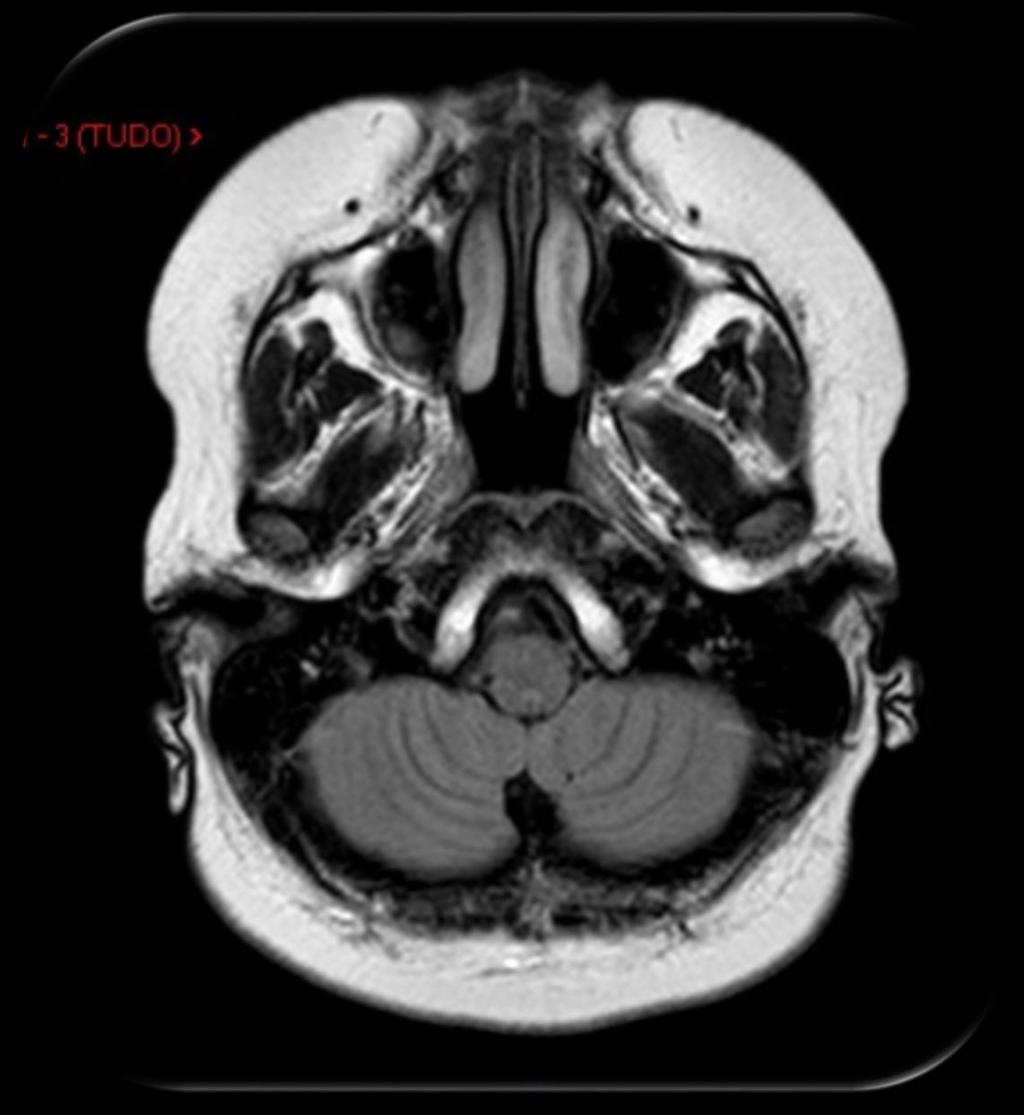 Concha nasal Conduto auditivo externo Seio maxilar Células