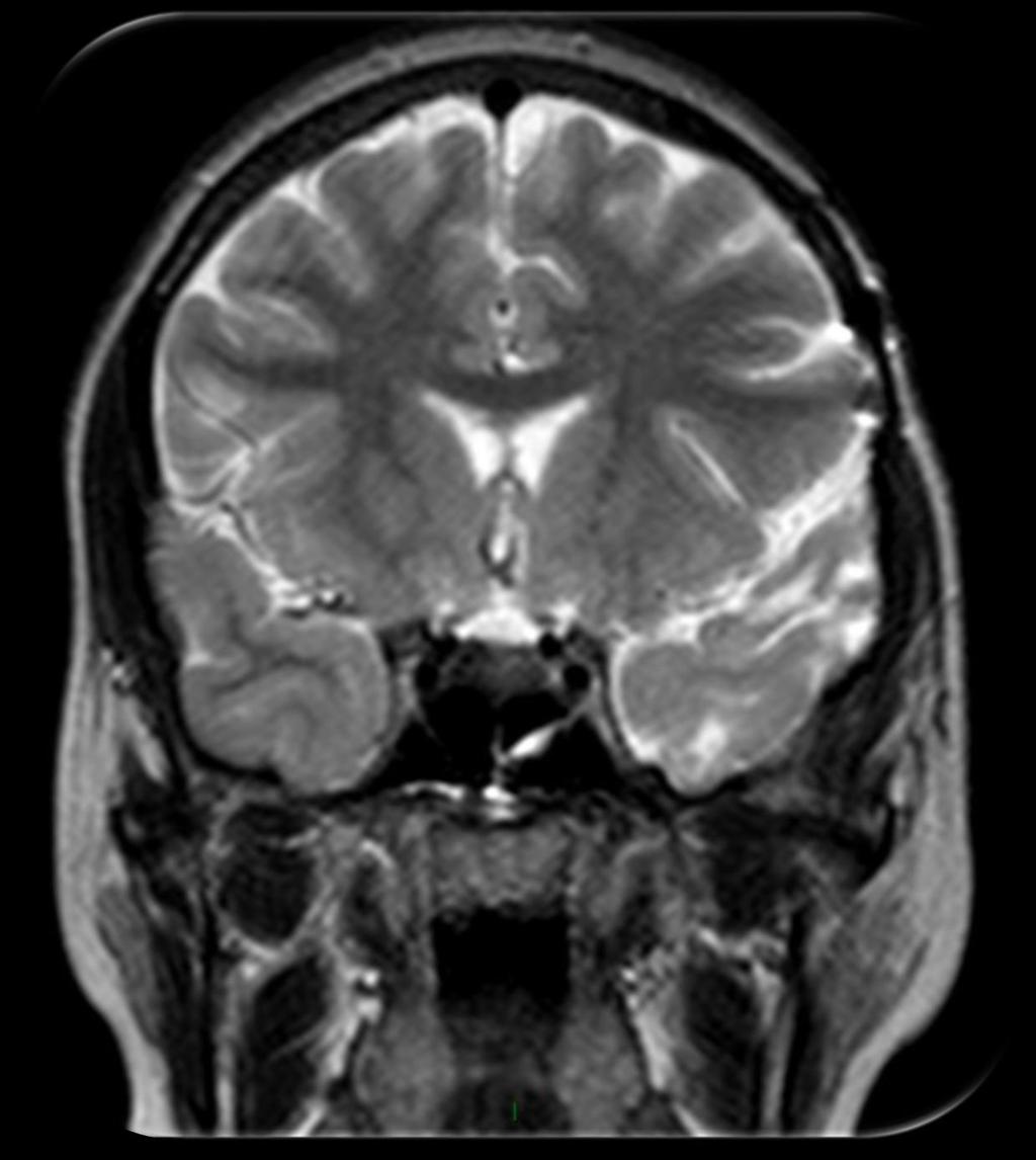 Ventrículo lateral (Corno anterior) Lobo frontal Núcleo caudado (cabeça) Capsula externa Putamen Artéria