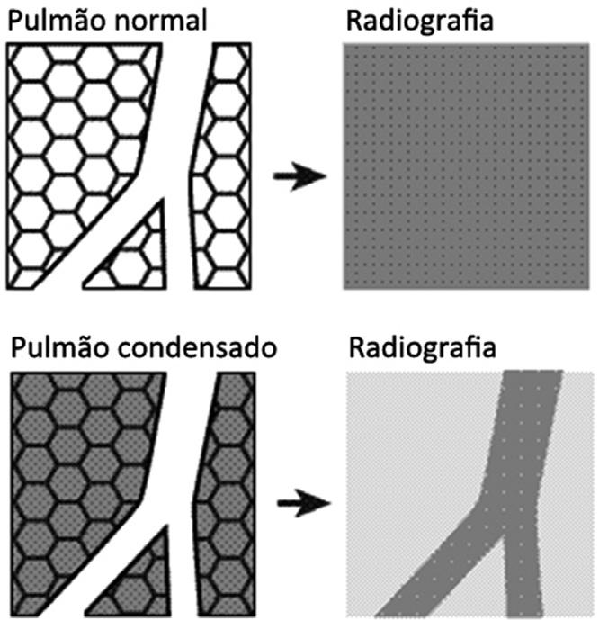 168 sic pneumologia 1. Introdução e definições A pneumonia é definida como um processo inflamatório (e infeccioso) do parênquima do pulmão.