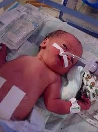 ASSISTÊNCIA IMEDIATA AO RECÉM-NASCIDO Necessidade de reanimação ao nascimento:» Ventilação com pressão