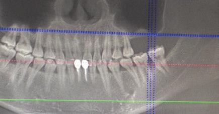 ELEVAÇÃO DO SEIO MAXILAR COM ACESSO CRESTAL Elevação bilateral do seio maxilar com acesso crestal Dr.
