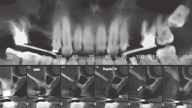 ELEVAÇÃO DO SEIO MAXILAR E ENXERTO ÓSSEO Elevação do seio maxilar com acesso lateral em combinação com regeneração óssea guiada Dr. João Batista César Neto, Dr.