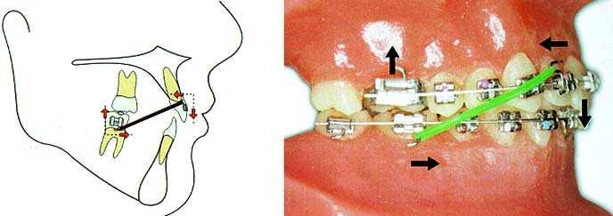 44 B) Arco mandibular: propiciam a inclinação dos incisivos inferiores para vestibular, trazem todo o arco mandibular para frente, causam força extrusiva nos molares inferiores.