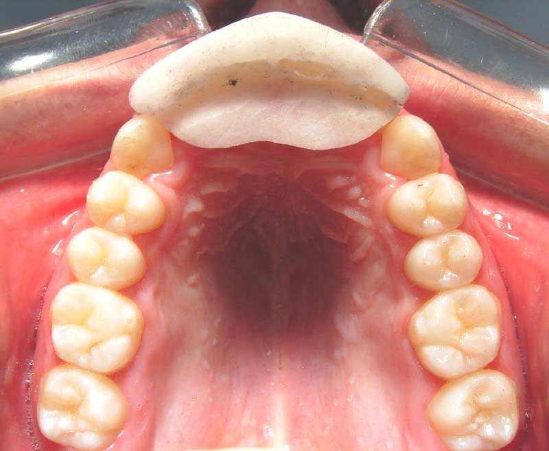 posição de RC (FIG. 5). FIGURA 5: Marcação do primeiro ponto de contato no Jig e no dente, simultaneamente, durante o fechamento em RC.