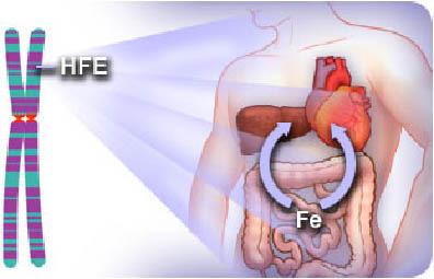 Hemocromatose