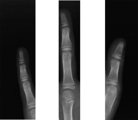 A posição dos dedos pode ser determinada na imagem a partir da posição da membrana de tecido mole presente entre um dedo e outro.