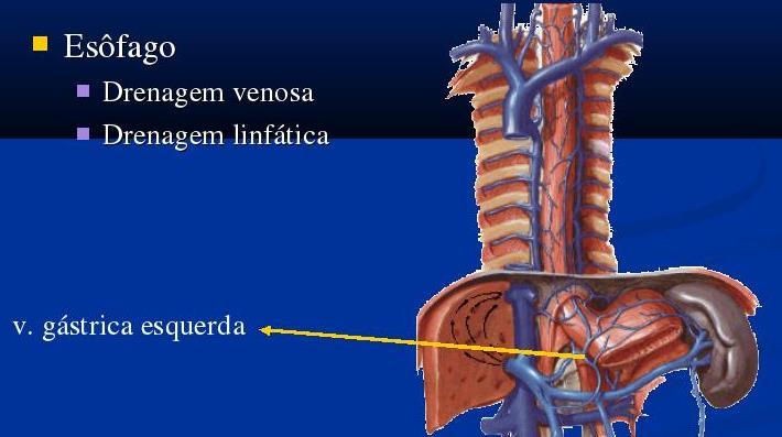 Esofago variz Relacionada à hipertensão portal Formação de canais colaterais de comunicação do sistemas porta e sistêmico Dilatação das veias