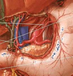 Arteriografia