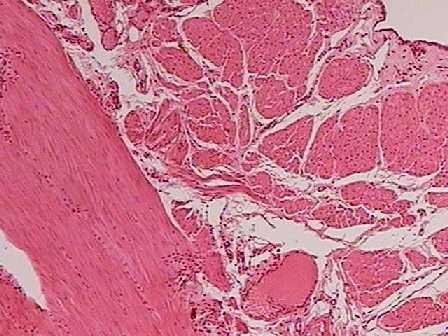 Esôfago Estreitamentos do esôfago: 1. Superior ou cricoide. 2. Médio ou aorticobronquial. 3. Inferior o diafragmático.