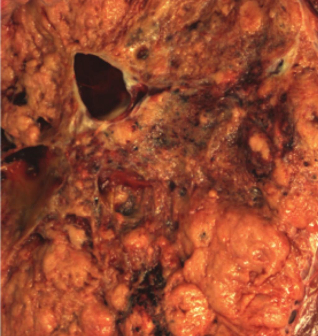 Ureter com 75 mm de comprimento e 5 mm de diâmetro, sem particularidades. Não se identificou glândula suprarrenal. O tipo histológico (OMS) foi carcinoma de células renais cromófobo (Fig.s 9 e 10).