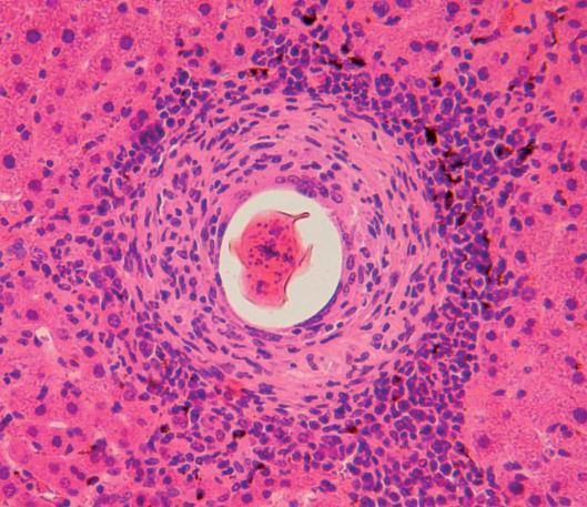 Pode ser assintomática Forma hepatointestinal