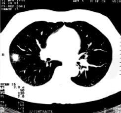 Insuficiência cardíaca (Cor pulmonale) Cianose Oxigenação deficiente Pele, dedos e