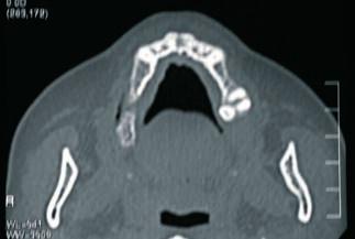 corte sagital Figura 4 - Vista maxilar com 4 implantes TiU RP e 2 implantes zygoma Figura 5 - All-on-4 mandibular com 4 implantes TiU RP Figura 6 - Reabilitação em função imediata total com próteses