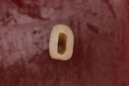 25 coroa-ápice usando-se um conjunto de lima para cada dez dentes; a obturação dos canais se deu com um cimento a base de óxido de zinco e eugenol (Fill Canal) e cones