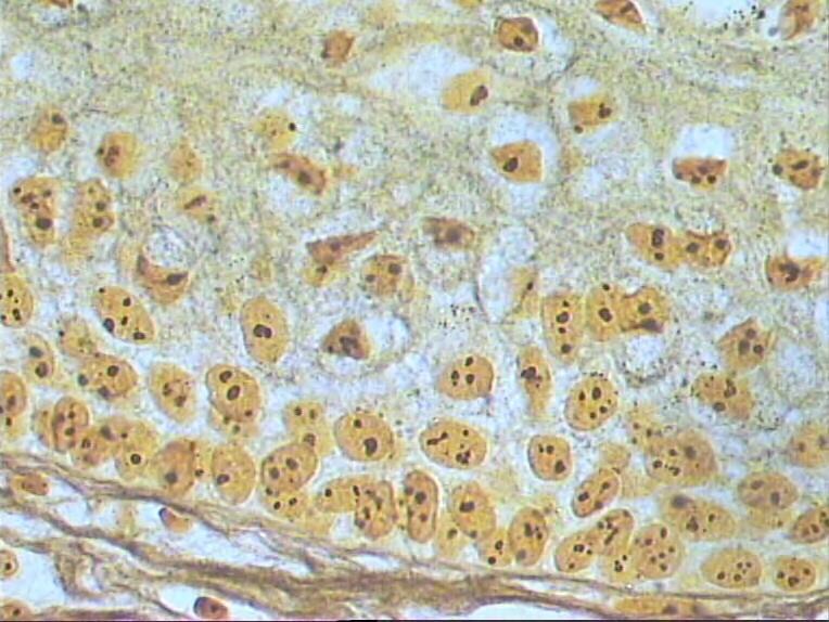 3.6 RESULTADO Na análise histopatológica o TOQ apresentava cavidade revestida por epitélio estratificado pavimentoso paraqueratinizado, composto por 5 a 8 camadas de células, exibindo aspecto