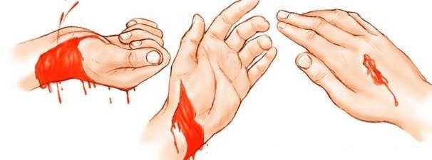 Conceitualmente a hemorragia é definida como um rompimento vascular que causa um extravasamento sanguíneo. Esse extravasamento pode acontecer externamente ou internamente.