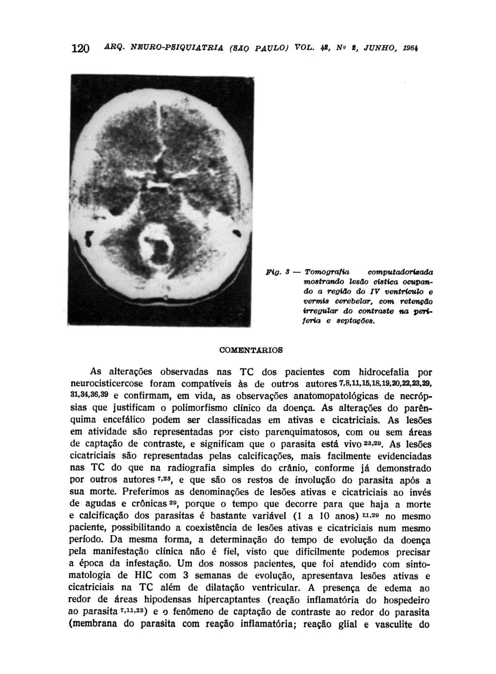 COMENTÁRIOS As alterações neurocisticercose observadas nas T C dos pacientes com hidrocefalia por foram compatíveis às de outros autores 7,8,11,15,18,19,20,22,23,29, 31,34,36,39 e confirmam, em vida,