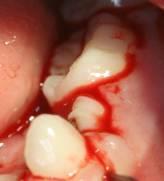 Dente Anquilosado Fusão anatômica do cimento ou dentina radicular ao osso alveolar, causando interrupção no ritmo de erupção do dente Arcada inferior é a mais afetada 1 molar decíduo inferior é o