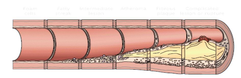 Fisiopatologia Factores de Risco Cardiovasculares Aterosclerose Formação de um trombo Eventos