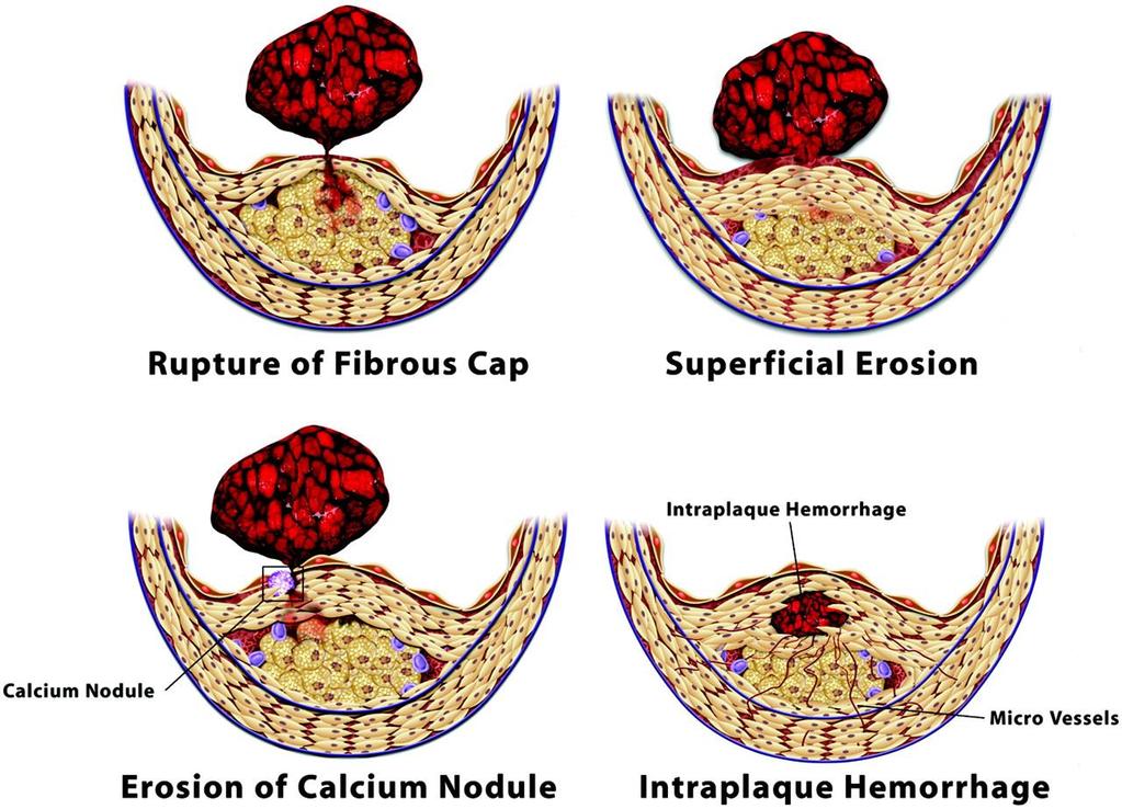 Fisiopatologia Conceito de placa