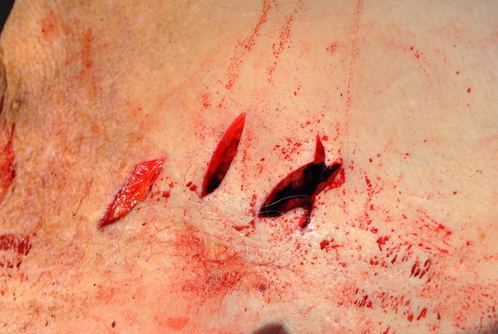 Tipo de Lesão Cortante agem por deslizamento do gume afiado sobre os tecidos possuem bordas regulares