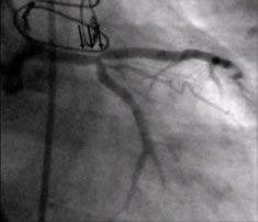 Artéria torácica interna esquerda ocluída proximal (seta grossa preta) É realizada coronariografia, na qual são demonstradas de forma exata as mesmas lesões