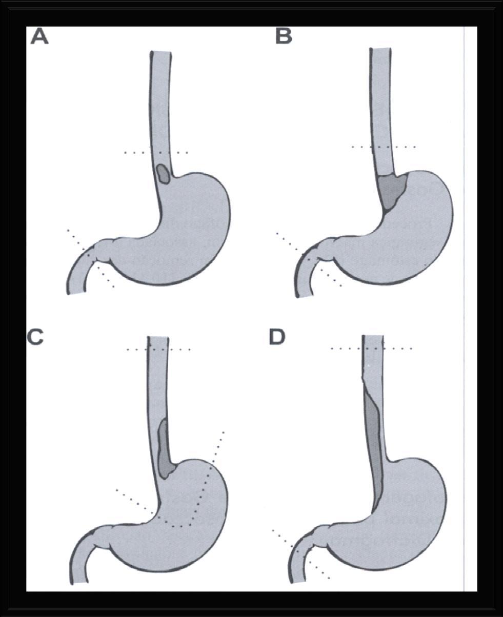 Tratamento cirúrgico Sallum,