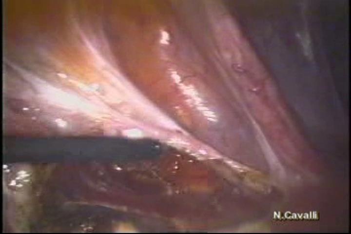 Histerectomia Laparoscópica Complicações - Inerentes a laparoscopia (enfisema subcutâneo, lesão de grandes