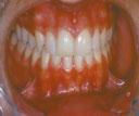 adequadas dos arcos dentários, a função restabeleceu-se naturalmente, mantendo-se estável ao longo do tempo.