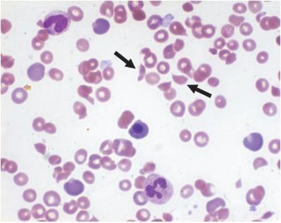 Figura 02: Esfregaço de sangue periférico, evidenciando esquizócitos em paciente com púrpura trombocitopênica trombótica. Disponível em: FALCAO, ZAGO, PASQUINI; 2013.