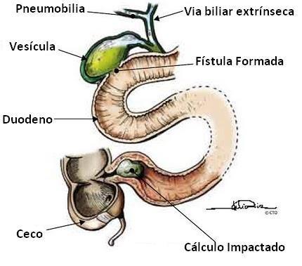 Figura 1 Foto esquemática do mecanismo de obstrução nos casos de Íleo Biliar 12 O relato de sintomas atribuíveis à árvore biliar é