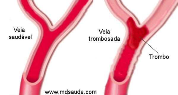 Complicações Vasculares/Circulatórias Flebite e/ou Tromboflebite: FLEBITE Inflamação de uma veia TROMBOFLEBITE - Inflamação de uma veia com formação de um coágulo trombo.