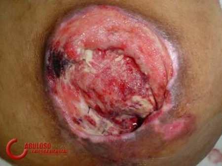 Úlceras por Pressão Úlceras por Pressão Causas: Pressão da pele em cama com lençóis molhados e/ou enrugados;