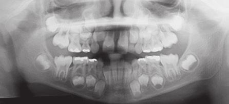 runetto,. R. FIGUR 3 - Radiografia panorâmica inicial. FIGUR 4 - Radiografia cefalométrica de perfil () e traçado cefalométrico () iniciais. de classe III.