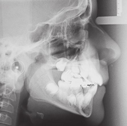 FIGUR 8 - Radiografia cefalométrica de perfil () e traçado cefalométrico () intermediários, após a primeira fase do