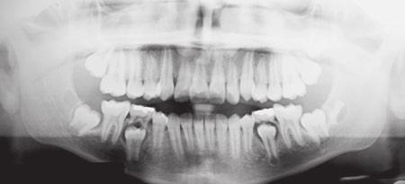 Má oclusão de Classe I de ngle, com tendência à classe III esquelética, tratada com controle de crescimento FIGUR 12 - Radiografia panorâmica intermediária (2).