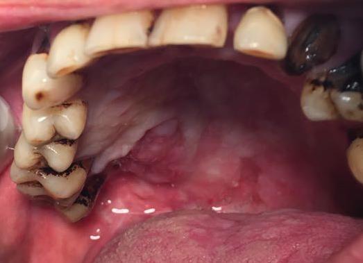 Dificuldade no diagnóstico de câncer de boca longe de um centro de referência: relato em série um laudo de uma biópsia realizada anteriormente com diagnóstico de Papiloma escamoso.
