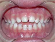 Sucção e respiração oral no desenvolvimento da dentição Apresença de hábitos de sucção e da respiração oral na infância tem correlação direta com alterações da oclusão dentária e do desenvolvimento