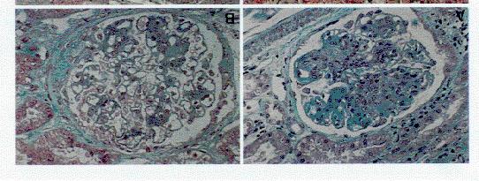 Possibilidade de transformação Classe Classe Classe Classe Tratamento Classe: : tratamento inespecífico p/ nefropatia : corticosteróides ides em altas doses, e : pulso de ciclofosfamida / corticóide