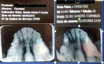 Mensurações: DATA LONGIT TRANSV 05/05/15 2cm 2cm 01/07/16 1,8cm 1,7cm Medidas da lesão na boca da