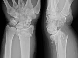 INTRODUÇÃO As fracturas distais do rádio são as mais comuns do membro superior 17% de todas as fracturas 75% das fracturas