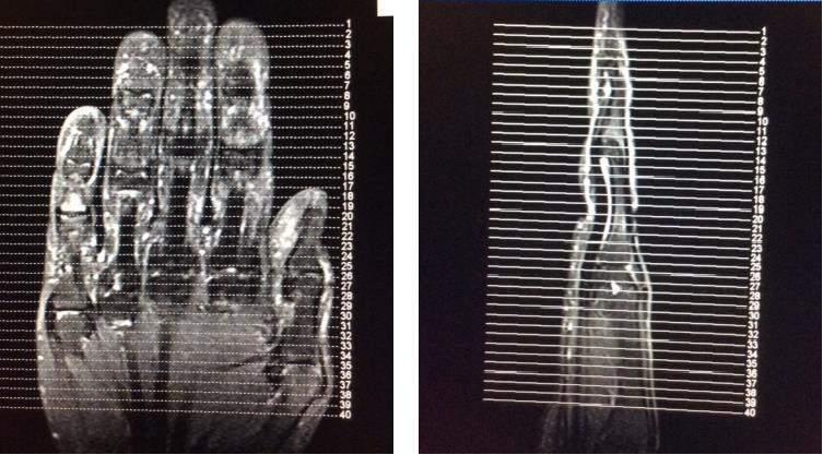 14 / 77 Mão/Dedo Coronal T1/DP Coronal T2 Fat (Fotografar) Sagital T2 Fat (Fotografar) Axial T2 Fat (Fotografar) Axial T1(Fotografar) Contraste (se necessário) Coronal T1 Fat Axial T1 Fat