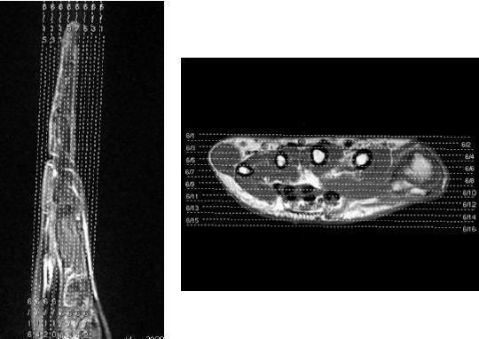 - Coronal: 15 / 77 Programar sobre a imagem no plano axial e sagital em seu maior eixo,