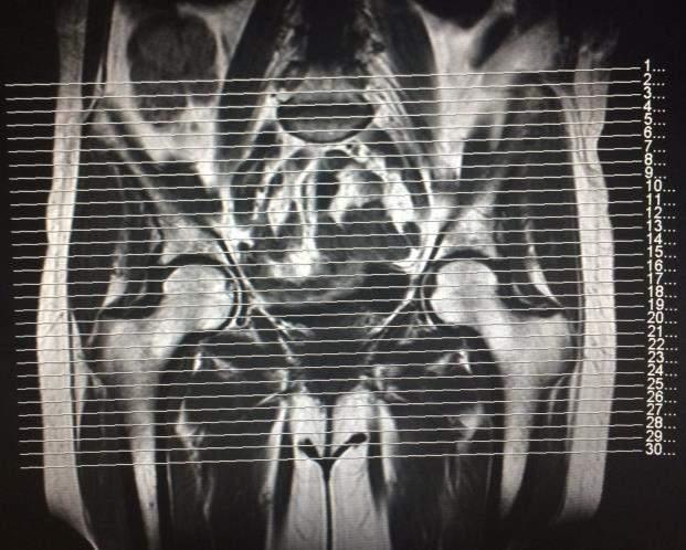 Bacia Coronal T1/DP Coronal T2 Fat (Fotografar) Axial T2 Fat (Fotografar) Axial T1(Fotografar) Contraste (se necessário) Coronal T1 Fat