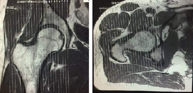 - Sagital reto: Programar a sequência pelo plano coronal de